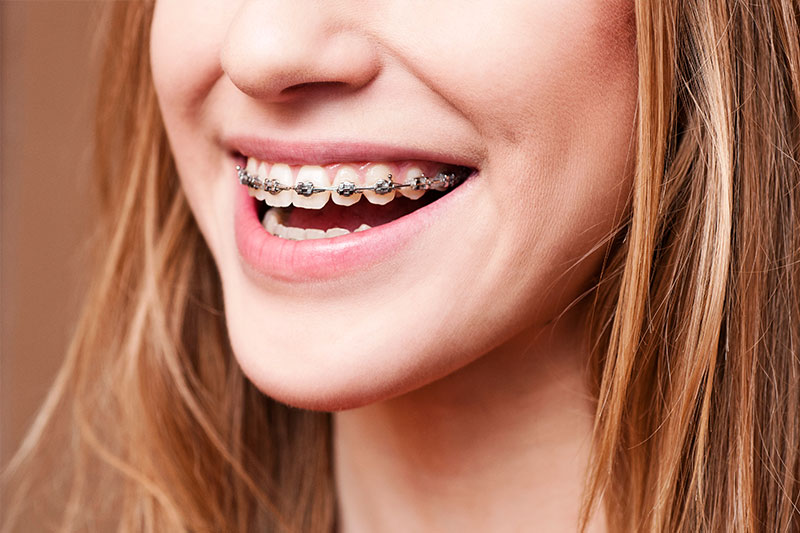 Orthodontics - AAA Dental Care, Phoenix Dentist