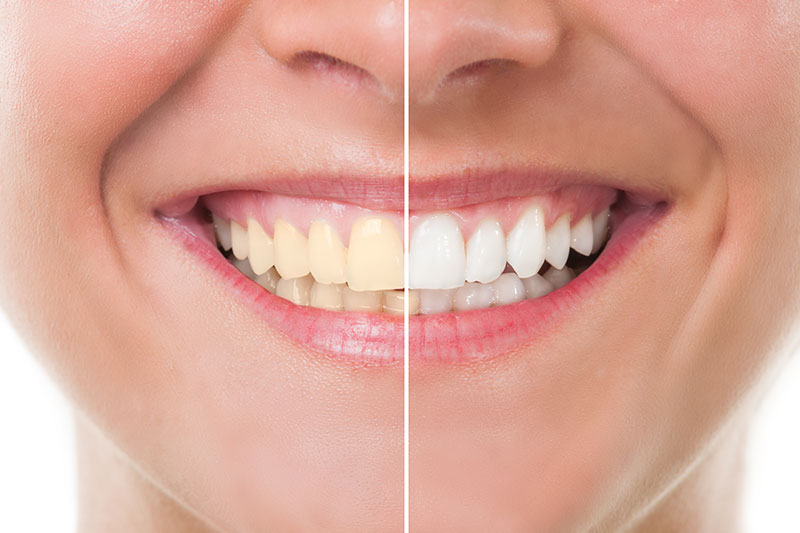 Teeth Whitening - AAA Dental Care, Phoenix Dentist